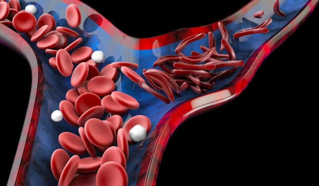 Supporting Sickle Cell Health