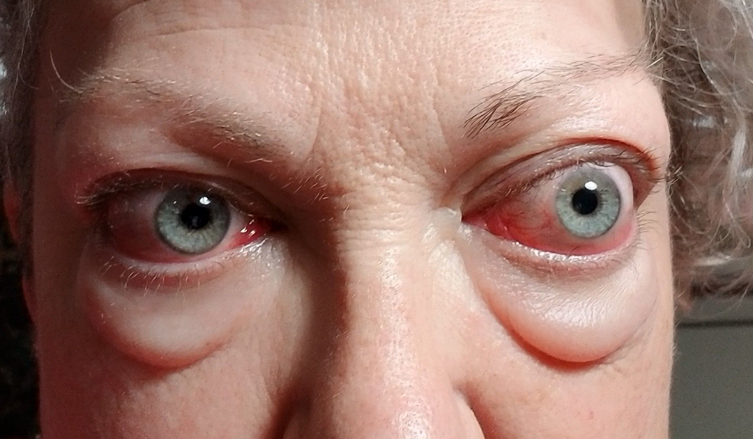 Graves’ Disease