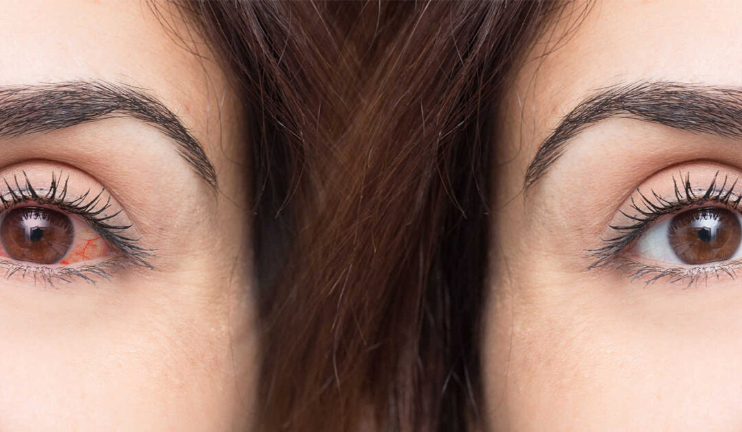 The “Dre Eye” Fix