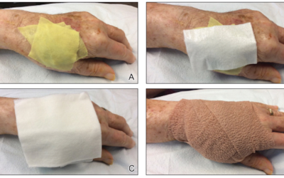 Faster Wound Healing