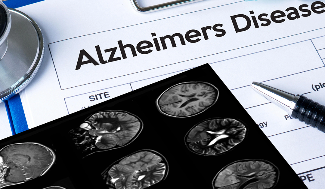 Alzheimer’s Is Rising—And It’s Not Just Age: The Nutritional Truth You Need to Know