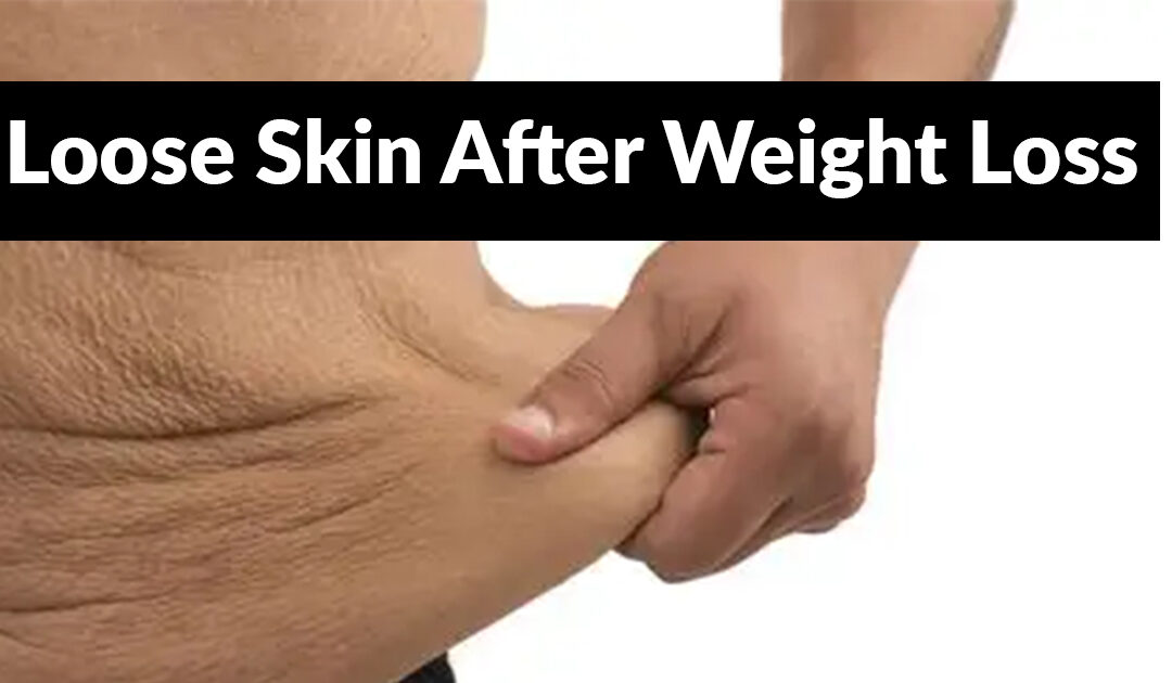 Loose Skin After Weight Loss: What You Can Do About It—And Why You Shouldn’t Let It Hold You Back