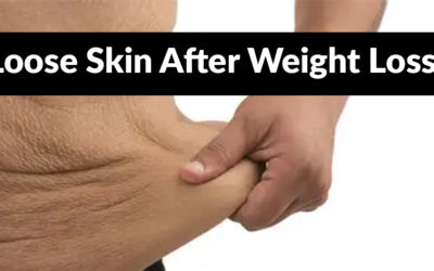 Loose Skin After Weight Loss: What You Can Do About It—And Why You Shouldn’t Let It Hold You Back