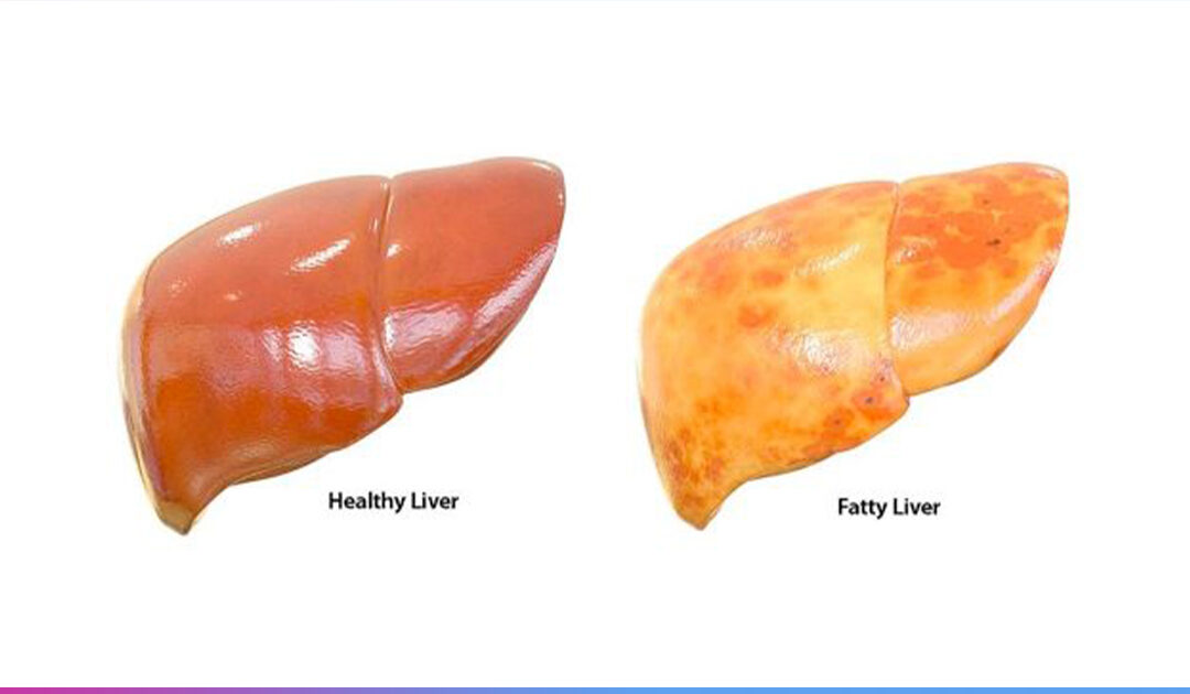 Got Fatty Liver? Specifically, Non-Alcoholic Fatty Liver Disease: What It Is, Why It’s Overlooked, and How to Reverse It Naturally